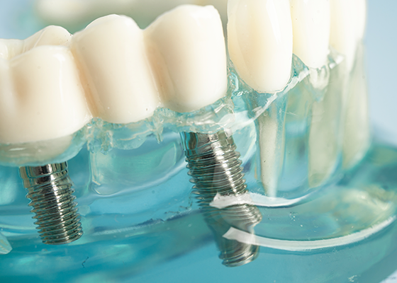 Tratamento com implantes dentários